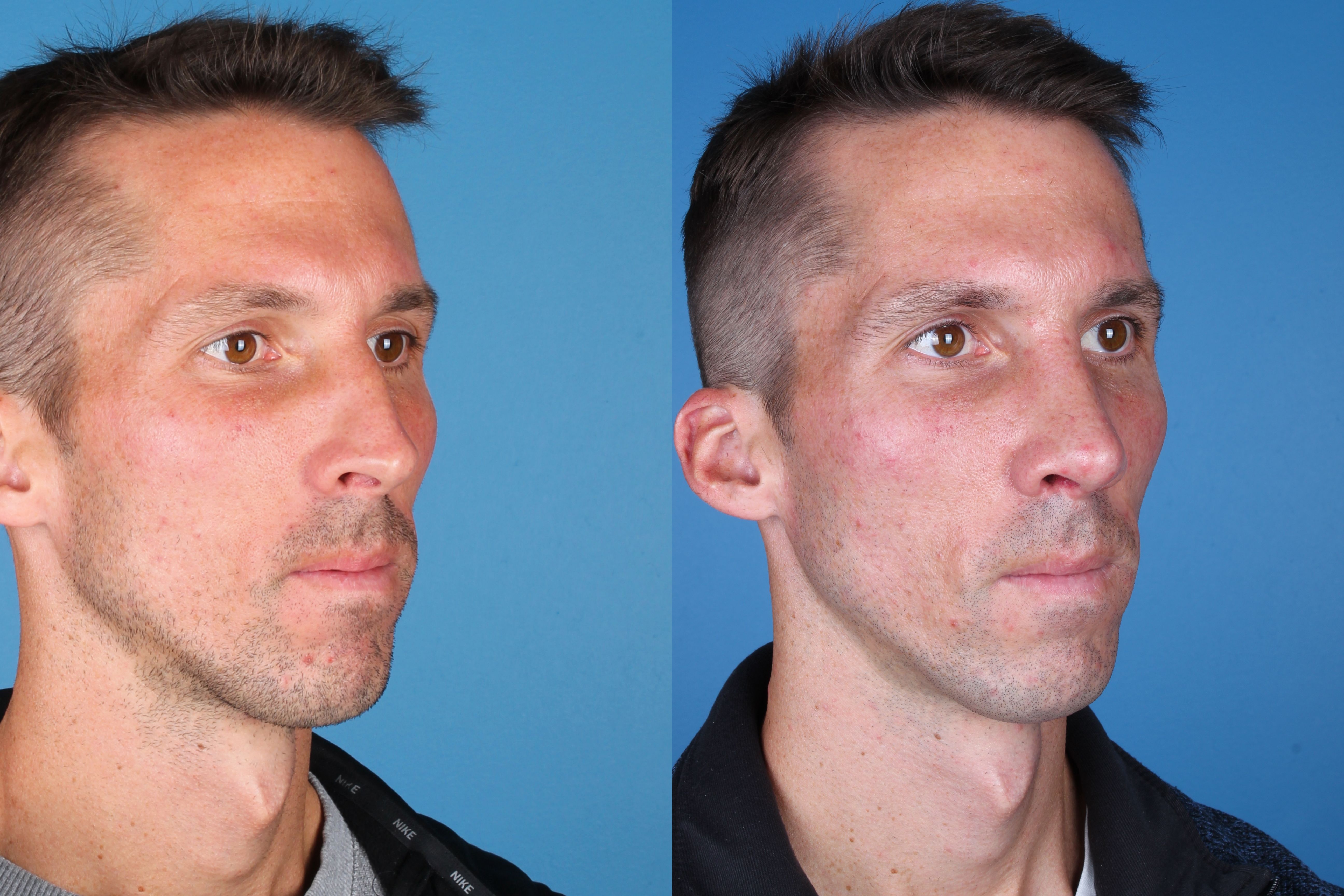 Denver Rhinoplasty Before And Afters Raval Facial Aesthetics